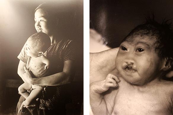 Two black and white photographs. The left photo shows a woman cradling a deformed starving infant. The right photo shows a close-up of an infant's face with a facial deformities from Agent Orange, held by an unseen person.