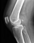 knee bones