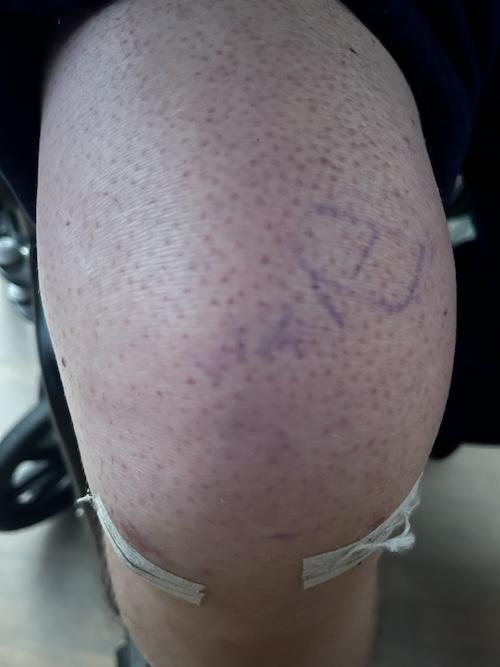 my knee, post-surgery