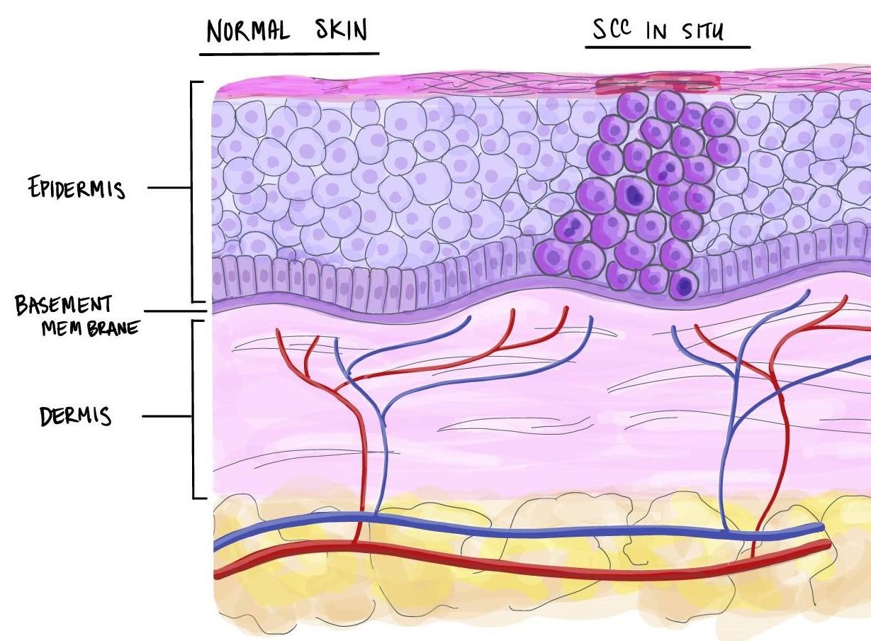 squamous cell carcinoma in situ