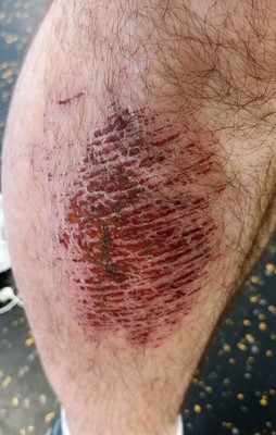 Leg with heavy scabbing from injury