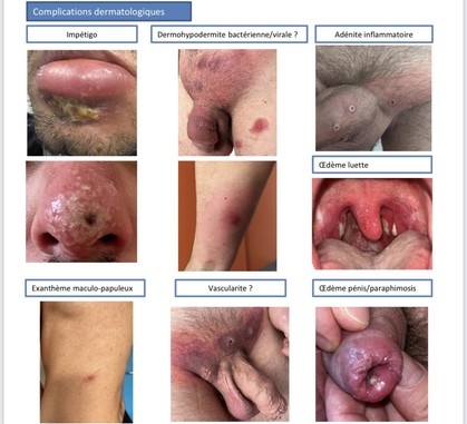 Images fournie par la Société française de dermatologie présentant les complications dermatologiques de la variole du singe : impétigo, dermohypodermite bactérienne/virale ? , adénite  inflammatoire, exanthème maculo-papuleux, vasculaire ? Oedème pénis / paraphimosis. 