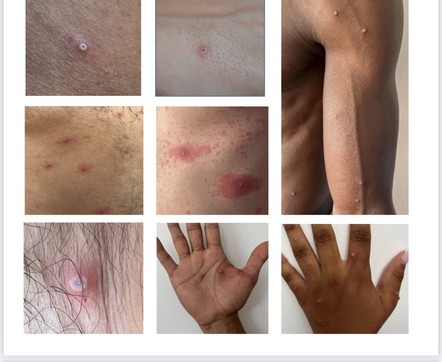 Images fournie par la Société française de dermatologie, Photos de boutons de variole dusonge sur la peau à différents endroits du corps : bras, mains jambes ...