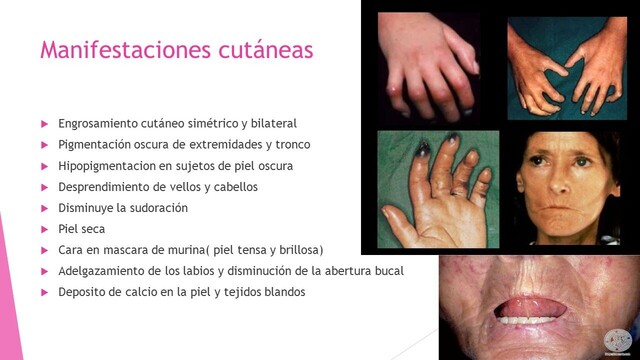 Manifestaciones cutáneas en la Esclerodermia #AltText4Me