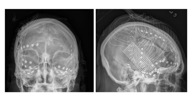 A net of electrodes was implanted in the brains of epilepsy patients as part of their treatment, which created a rare opportunity for neuroscientists to record from their brains while they listened to music.Credit...Peter Brunner
