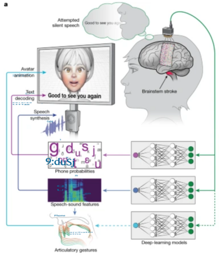 The figure shows the principle of decoding. A volunteer was implanted with a 253-channel, high-electrode-density ECG array 18 years after suffering a brainstem stroke. The device was placed directly on the brain. Processed neural activity was used to learn deep learning models to predict speech sound features and articulatory gestures, decode text, and generate spoken language and animate a virtual avatar.