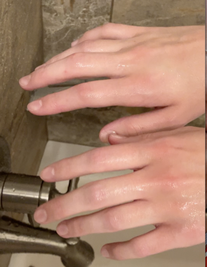 A still from a video of a teen's fingers trembling in the shower - a suspected symptom of vascular compression. 