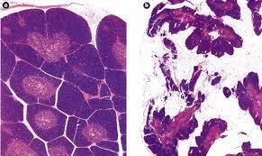 On the left is a young thymus able to generate naive T-cells capable of fighting infections and many cancers. On the left is an older one. Clearly, the older thymus is less functional than the younger one. 
Everyone's thymus "involutes" or degenerates throughout their lives. As the thymus becomes less functional, your ability to fight novel pathogens weakens and eventually ends. 

