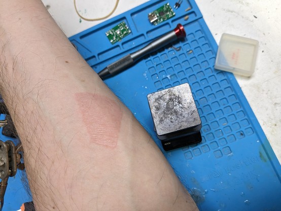 An underside of an arm with a square (30mm  x 30mm) red burn patch from the hot plate also in the photo