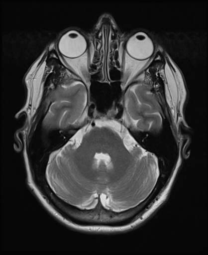 Original MRI section, made with the 3D-Slicer medical imaging package.
(NB: You own your medical data. You can request your scans, and should receive DICOM files, which you can view with free and open source software).