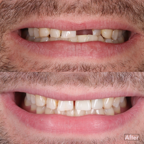 Replacing Lost Teeth
