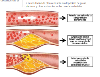 La acumulación de placa consiste en depósitos de grasa,
colesterol y otras sustancias en las paredes arteriales