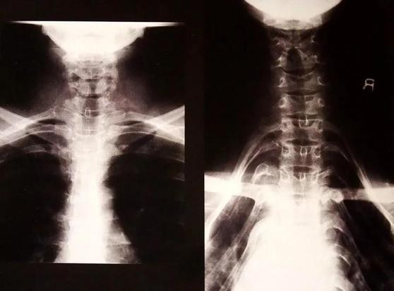 Radiografía de una mujer padaung, donde se observan las costillas inclinadas hacia abajo.