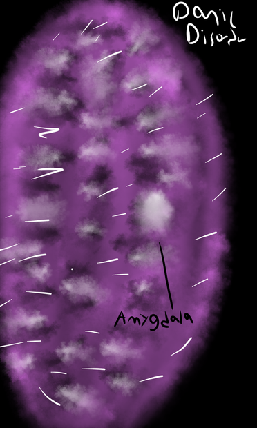 Brain with panic disorder
