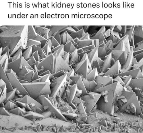 Closeup of a kidney stone under an electron microscope