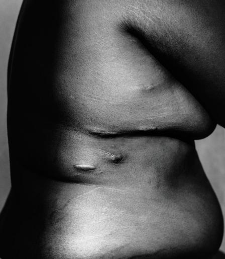 Close-up black and white image of a person's torso, highlighting skin texture and visible stretch marks.