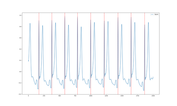 ECG visualisation