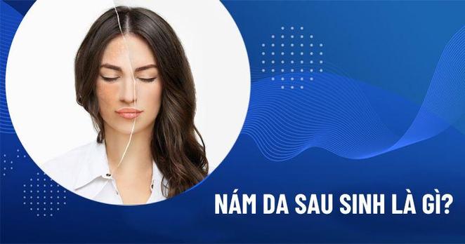 nám da sau sinh