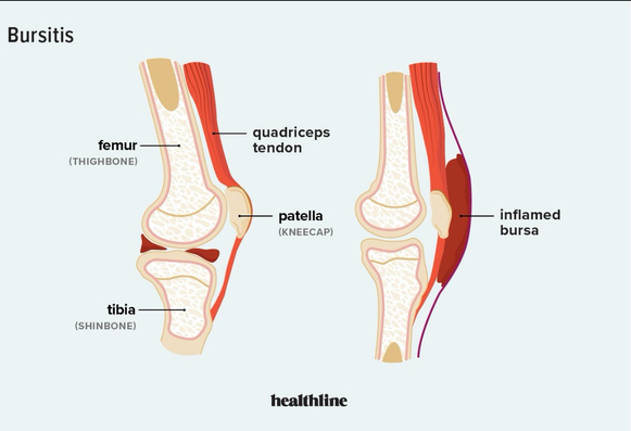 Diagram of knee and knee problems 