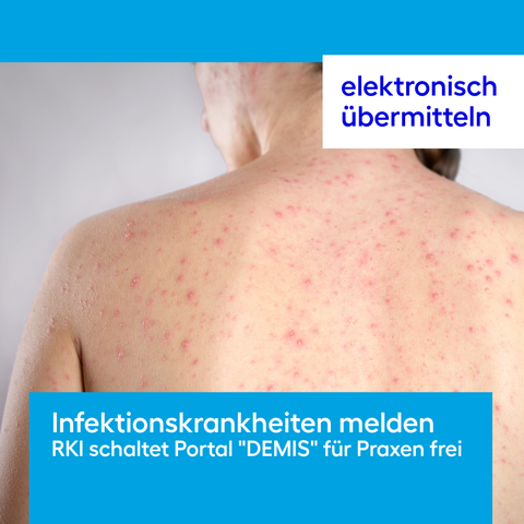 elektronisch übermitteln -
Infektionskrankheiten melden:
RKI schaltet Portal "DEMIS" für Praxen frei
