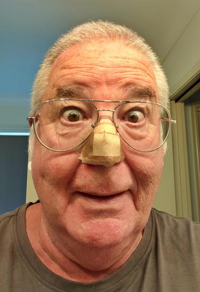 An image of Alan Crawford with a bandaged nose.