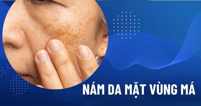 nám da vùng má