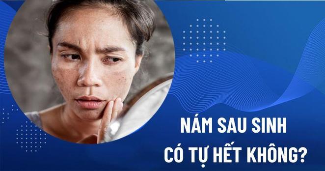 nám sau sinh có tự hết không