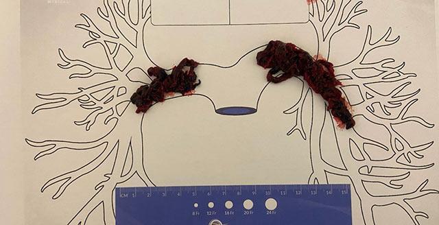 Visualisation de thrombus + schéma – explication clinique