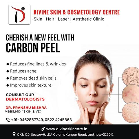 carbon peel treatment