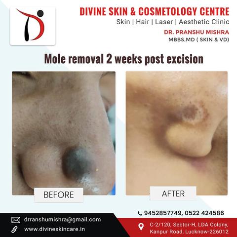 mole removal in divine skin and cosmetology center