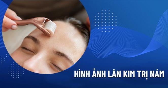 lăn kim trị nám da
