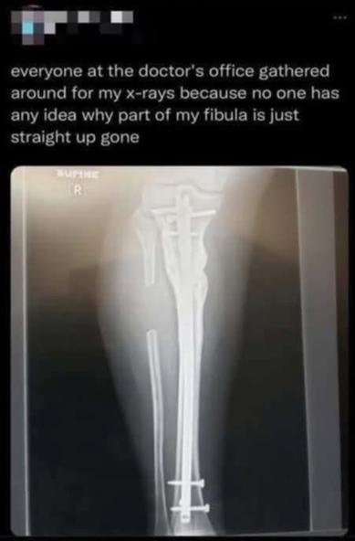 everyone at the doctor's office gathered around for my x-rays because no one has any idea why part of my fibula is just straight up gone

[x-ray of leg and part of her fibula is gone]
