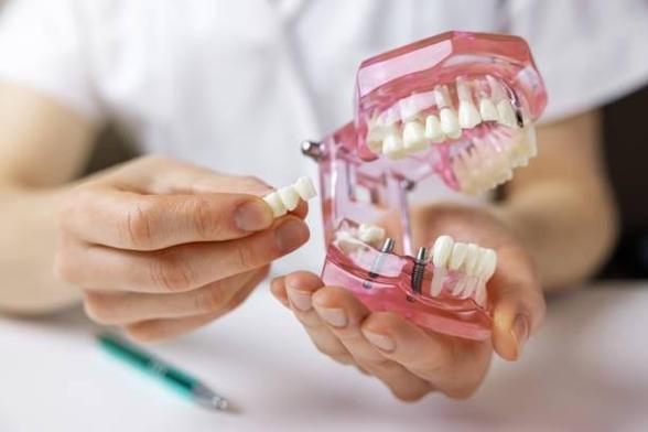Dental Bridges for Missing Teeth in Benalla