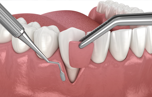 Gum Recession and Its Treatment