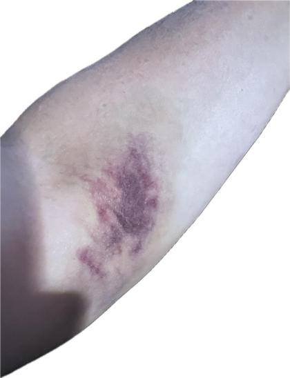 Picture of my light skinned arm with a significant amount of light bruising in the crook of my elbow.