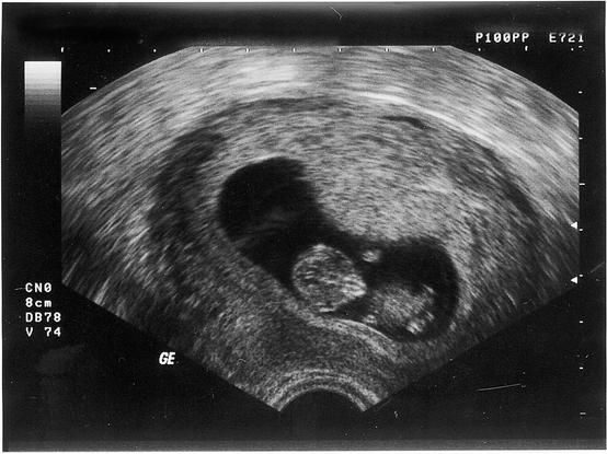 Ultraschallbild eines Fötus im Uterus der Mutter