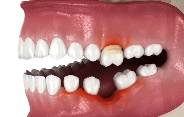 Periodontal Disease Prevention