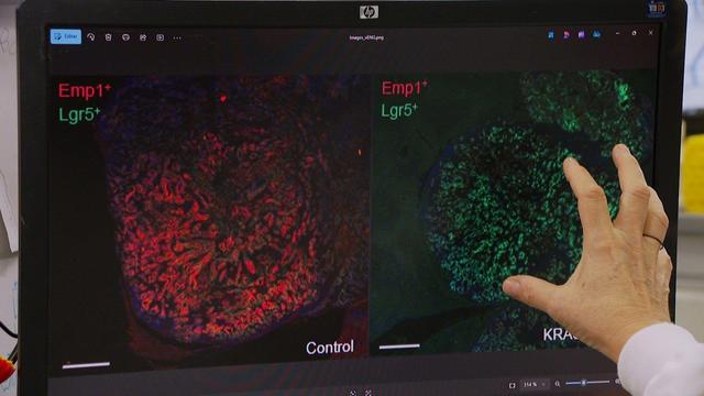 A l'esquerra, en vermell, les cèl·lules metastàtiques; a la dreta, en verd, les cèl·lules amb el gen KRAS inhibit (3CatInfo)