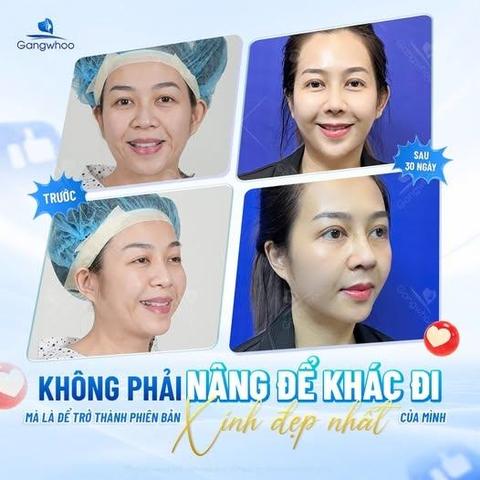 cách massage mũi sau nâng