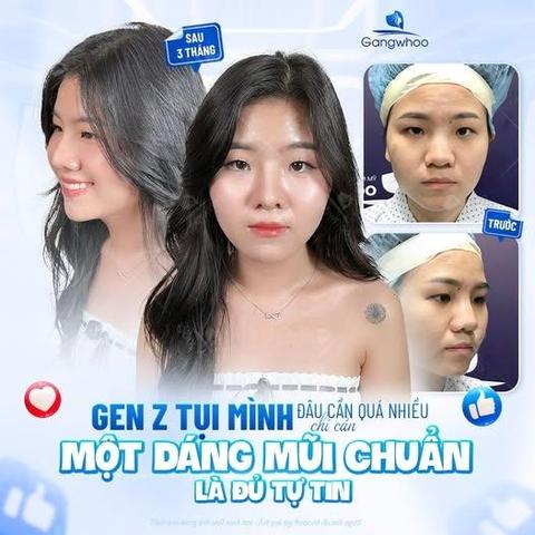 cách nâng mũi bằng thìa