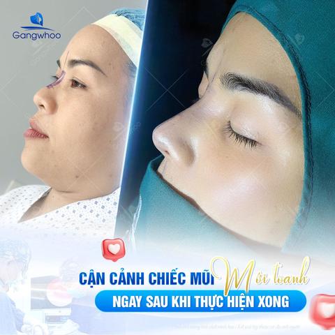 chườm nóng sau nâng mũi