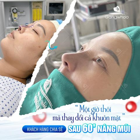 mang thai có nâng mũi được không