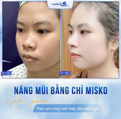 Nâng mũi bằng chỉ Misko giúp nâng sống mũi nhẹ nhàng, không đau nhiều và hầu như không cần nghỉ dưỡng. Lựa chọn tuyệt vời cho những ai thích vẻ đẹp tự nhiên.
