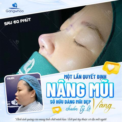 có kinh có nâng mũi được không