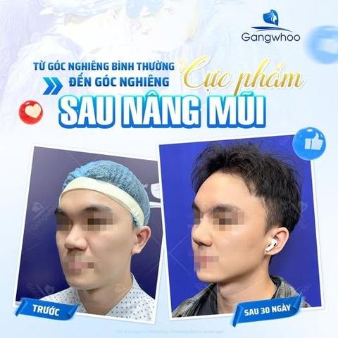 có nên nâng mũi bằng mỡ tự thân