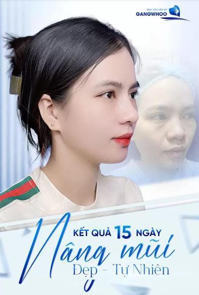 Khám phá kỹ thuật nâng mũi bằng chỉ Hàn Quốc, giải pháp thẩm mỹ hiện đại giúp nâng sống mũi, tạo đầu mũi thon gọn mà không cần phẫu thuật. Phương pháp này nhanh chóng, an toàn, ít xâm lấn và mang lại dáng mũi tự nhiên, cân đối với khuôn mặt. Lựa chọn hoàn hảo cho ai muốn thay đổi ngoại hình một cách nhẹ nhàng và hiệu quả lâu dài.