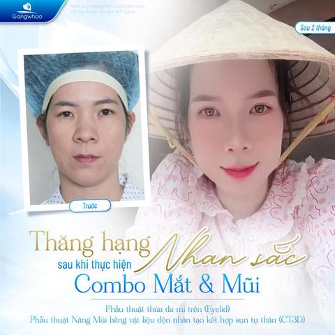 có nên nâng mũi không