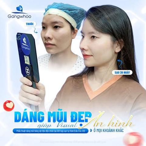 có nên nâng mũi sau khi nâng ngực