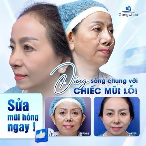 dấu hiệu bị mưng mủ sau khi nâng mũi