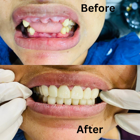Before and after teeth cap treatment